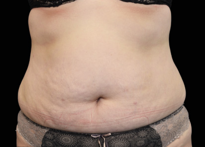 exilis ultra 360