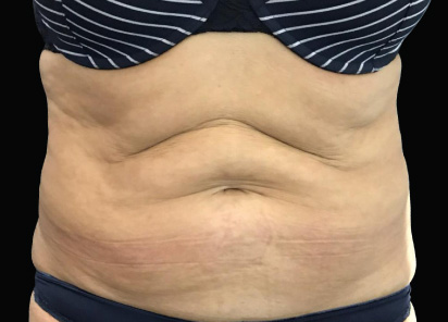 exilis ultra 360