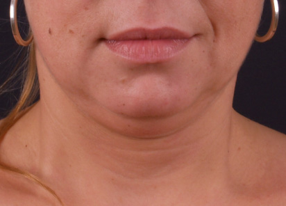 exilis ultra 360