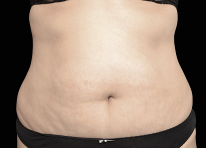 exilis ultra 360