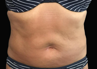exilis ultra 360