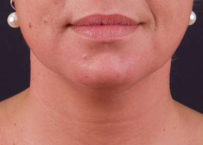 exilis ultra 360