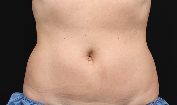 coolsculpting