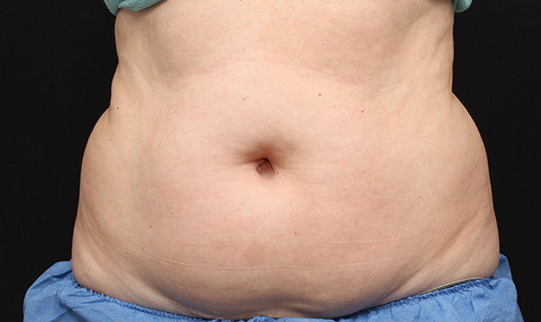 coolsculpting
