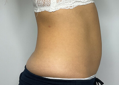 antes/before