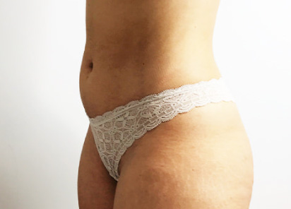 antes/before