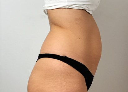 antes/before