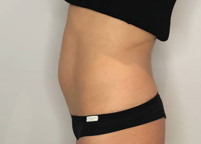 antes/before