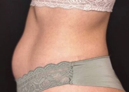 antes/before